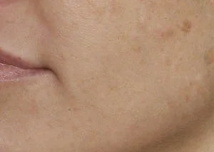 melasma marron medio